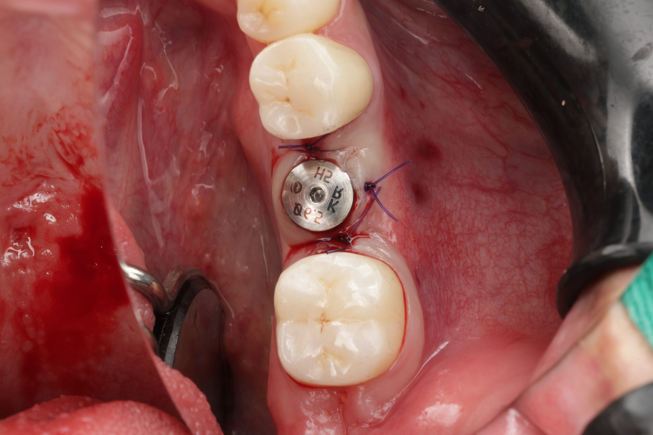 Cấy ghép Implant đơn lẻ